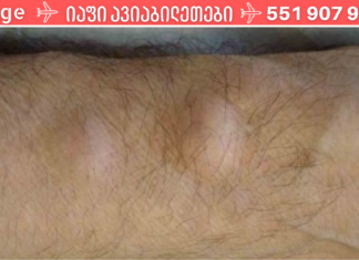 როგორ მოვიშოროთ ცხიმოვანი ქსოვილი (ლიპომები) ხალხური საშუალების დახმარებით!?