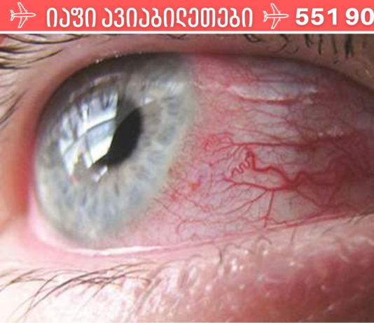 ალბათ არა ერთხელ გქონიათ თვალები გაღიზიანებული, შესაბამისად დაგაინტერესებთ მისი მკურნალობის ბუნებრივი საშუალებებით, არა? მაშინ, სრულად გაეცანით ინფორმაციას. .