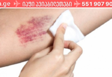 8 ხალხური მეთოდი სისხლჩაქცევებისგან თავის დასაღწევად!