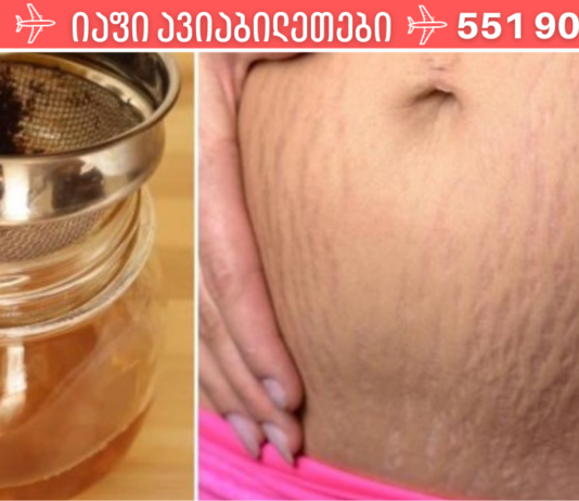 მოიშორეთ სტრიები ამ 7 გასაოცარი მეთოდის დახმარებით. .!