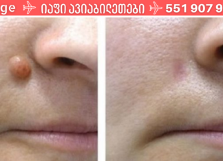 უსაფრთხო და უმტკივნეულო საშუალება მეჭეჭებისგან თავის დასაღწევად!