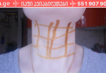 თუ იოდის ბადეს სწორად და გონივრულად გამოიყენებთ, დარწმუნებულნი იყავით, რომ დაივიწყებთ ჯანმრთელობის შემაშფოთებელი პრობლემებს..