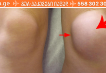 წლების განმავლობაში მიგროვდებოდა მუხლებში სითხე და მუდმივად ვიტანჯებოდა ამ მდგომარეობით, მანამ ეს სასწაული რეცეპტი არ აღმოვაჩინე!