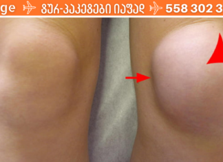 წლების განმავლობაში მიგროვდებოდა მუხლებში სითხე და მუდმივად ვიტანჯებოდა ამ მდგომარეობით, მანამ ეს სასწაული რეცეპტი არ აღმოვაჩინე!