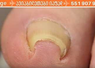 რა იწვევს და როგორ მოვუაროთ ჩაზრდილ ფრჩხილს?! ყველაზე აქტუალური პრობლემის მარტივი გადაჭრა..