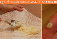 უსიამოვნო კოჟრები და ხორცმეტები, რომლებიც ხშირად გვიჩნდება კანზე სამუდამოდ გაქრება თუ ამ რეცეპტს გამოიყენებთ!