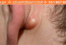 მოიშორეთ ცხიმოვანი კისტები ძალიან სწრაფად, მარტივად და ეფექტურად !