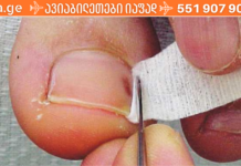 ჩაბრუნებული ფრჩხილის პრობლემას სახლშიც მარტივად მოაგვარებთ ქირურგიული ჩარევების გარეშე! აი ასე. .