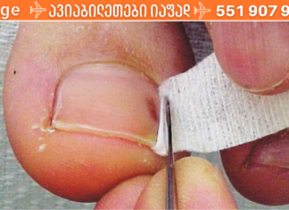 ჩაბრუნებული ფრჩხილის პრობლემას სახლშიც მარტივად მოაგვარებთ ქირურგიული ჩარევების გარეშე! აი ასე. .