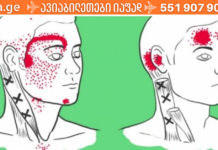 ვეღარ უძლებთ შაკიკით გამოწვეულ ტკივილებს? გაეცანით სტატიას აი რა უნდა მოიმოქმედოთ ამ დროს!