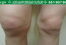 თქვენც გიგროვდებათ სითხე მუხლის სახსარში? იხილეთ მისგან თავის დაღწევის უმარტივესი გზა!