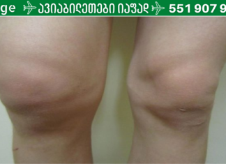 თქვენც გიგროვდებათ სითხე მუხლის სახსარში? იხილეთ მისგან თავის დაღწევის უმარტივესი გზა!