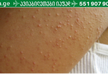 თუ თქვენც გაწუხებთ მსგავსი გამონაყარი, მაშინ დაუყოვნებლივ უნდა შეწყვიტოთ ამ საკვების მიღება!