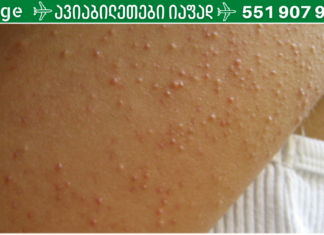 თუ თქვენც გაწუხებთ მსგავსი გამონაყარი, მაშინ დაუყოვნებლივ უნდა შეწყვიტოთ ამ საკვების მიღება!