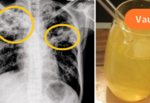 5 პროდუქტი, რომელიც სწრაფად აშორებს ნახველს და ლორწოს ფილტვებიდან!