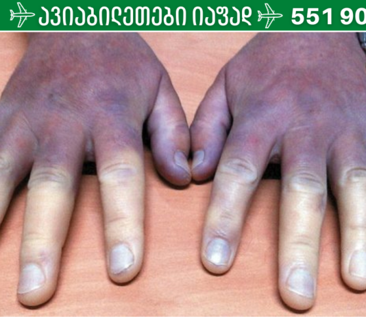გაფრთხილება: თუ ხელები მუდმივად ცივი გაქვთ, შესაძლოა თქვენს ჯანმრთელობას სერიოზული საფრთხე ემუქრება.