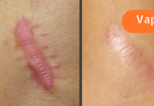 ნაწიბურების შეხორცება ბუნებრივი გზით: რომელი საშუალებაა უფრო ეფექტური?