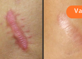 ნაწიბურების შეხორცება ბუნებრივი გზით: რომელი საშუალებაა უფრო ეფექტური?