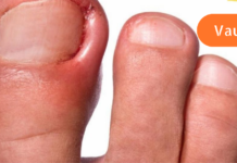 ჩაზრდილი ფრჩხილების მოვლა სახლში მარტივად შეგიძლიათ. არ არის საჭირო ოპერაცია!