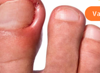 ჩაზრდილი ფრჩხილების მოვლა სახლში მარტივად შეგიძლიათ. არ არის საჭირო ოპერაცია!