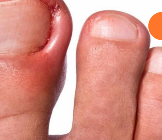 ჩაზრდილი ფრჩხილების მოვლა სახლში მარტივად შეგიძლიათ. არ არის საჭირო ოპერაცია!