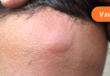 როგორ მოვიშოროთ კანიდან ლიპომები სახლის პირობებში?