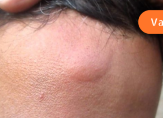 როგორ მოვიშოროთ კანიდან ლიპომები სახლის პირობებში?