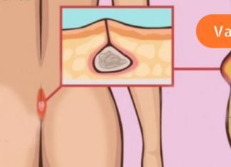 რა არის პილონიდალური დაავადება და როგორ ვუმკურნალოთ მას ?!