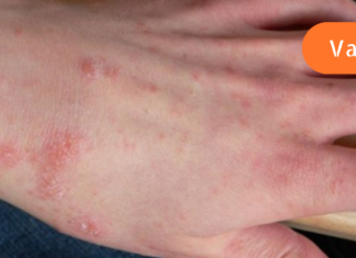 საუკეთესო ბუნებრივი ანტიჰისტამინები ალერგიული რეაქციების წინააღმდეგ საბრძოლველად!