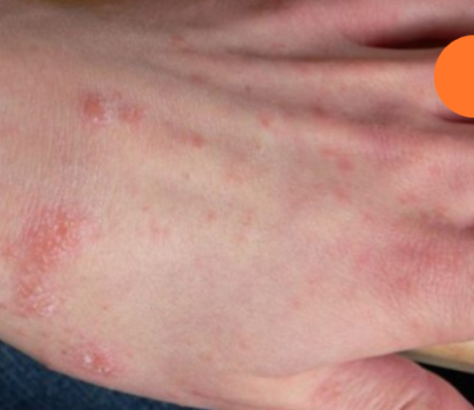 საუკეთესო ბუნებრივი ანტიჰისტამინები ალერგიული რეაქციების წინააღმდეგ საბრძოლველად!