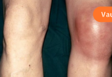 როგორ მოვიშოროთ ტკივილი და შეშუპება მუხლებში? მაშინაც კი, თუ 70 წელზე მეტის ხართ!