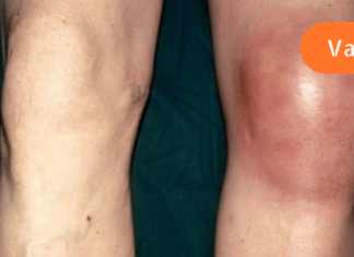 როგორ მოვიშოროთ ტკივილი და შეშუპება მუხლებში? მაშინაც კი, თუ 70 წელზე მეტის ხართ!