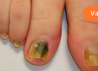 მოიშორეთ ფრჩხილის სოკო მხოლოდ 3 ინგრედიენტის გამოყენებით!