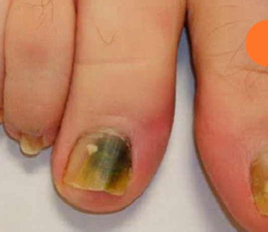 მოიშორეთ ფრჩხილის სოკო მხოლოდ 3 ინგრედიენტის გამოყენებით!