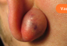 როგორ მოვიშოროთ ცისტები ბუნებრივად?! გავრცელებული პრობლემის მარტივი გადაწყვეტა