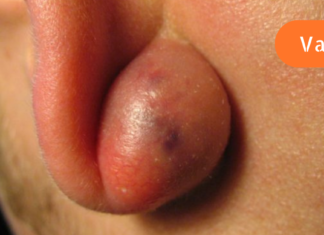 როგორ მოვიშოროთ ცისტები ბუნებრივად?! გავრცელებული პრობლემის მარტივი გადაწყვეტა