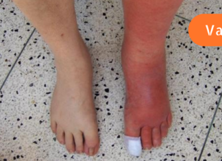 ტრადიციული ნარევი, რომელიც დაავადება “წითელი ქარის” დროს მყისიერად დაგეხმარებათ!