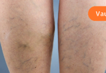 “ვენების პრობლემა წლებია მაწუხებს თუმცა მის დასამარცხებლად ამ საშუალების შესახებ ახლახანს შევიტყვე. .”