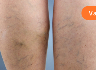 “ვენების პრობლემა წლებია მაწუხებს თუმცა მის დასამარცხებლად ამ საშუალების შესახებ ახლახანს შევიტყვე. .”