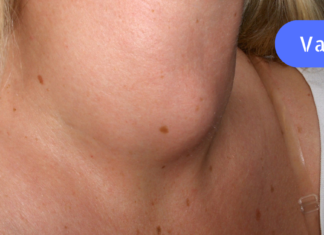 სწრაფი და მარტივი საშუალება ფარისებრი ჯირკვლის პრობლემების მოსაშორებლად!