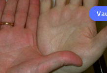 სასწრაფოდ! თუ ჰემოგლობინის დონე მნიშვნელოვნად დაგიქვეითდათ აუცილებლად მიიღეთ ეს საშუალება