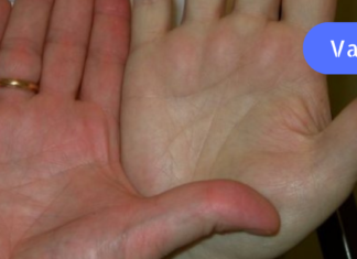 სასწრაფოდ! თუ ჰემოგლობინის დონე მნიშვნელოვნად დაგიქვეითდათ აუცილებლად მიიღეთ ეს საშუალება