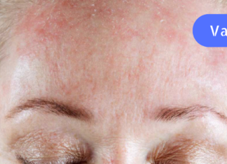 როგორ მოვიშოროთ მშრალი კანი ეფექტურად ამ 8 სახლის საშუალებით!