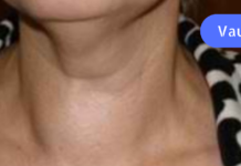 უკვე რამდენიმე წელია ამ საშუალებით ვმკურნალობ! ვისაც ჩიყვი აწუხებს, წამლად გამოადგება თეთრი ხახვი, რომელიც აპატარავებს ჩიყვს