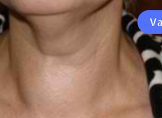 უკვე რამდენიმე წელია ამ საშუალებით ვმკურნალობ! ვისაც ჩიყვი აწუხებს, წამლად გამოადგება თეთრი ხახვი, რომელიც აპატარავებს ჩიყვს