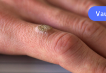 გასაოცარი ეთერზეთი, რომელიც აშორებს მეჭეჭებსა და ინფექციებს!