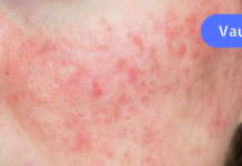 როგორ გავუმკლავდეთ ზამთრის ატოპიურ დერმატიტს ! მიიღეთ და გაითვალისწინეთ რჩევები!