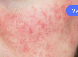 როგორ გავუმკლავდეთ ზამთრის ატოპიურ დერმატიტს ! მიიღეთ და გაითვალისწინეთ რჩევები!