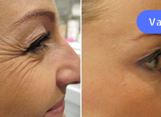 სასწაული საშუალებები, რომლებიც ამცირებს სიბერის თანმდევ პროცესს- ნაოჭებს!!