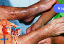 ფანტასტიკური რეცეპტი, რომელიც ხსნის თრომბებს: ეს ნამდვილი ხსნაა ვარიკოზული ვენებით დაავადებული ადამიანებისთვის!